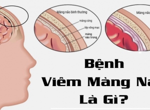 Tổng Quan Bệnh Viêm Màng Não – Nguyên Nhân, Dấu Hiệu Bệnh Và Cách Điều Trị